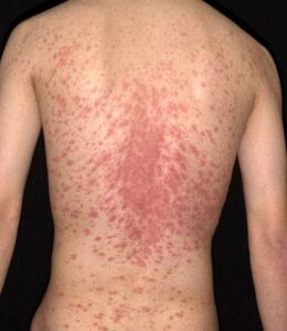 Skin Fungal Infection Laser Treatment