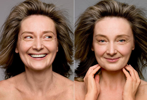 Liposuction for Aging Skin