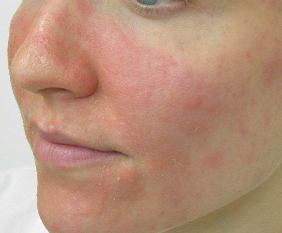 A woman with red spots on her face.