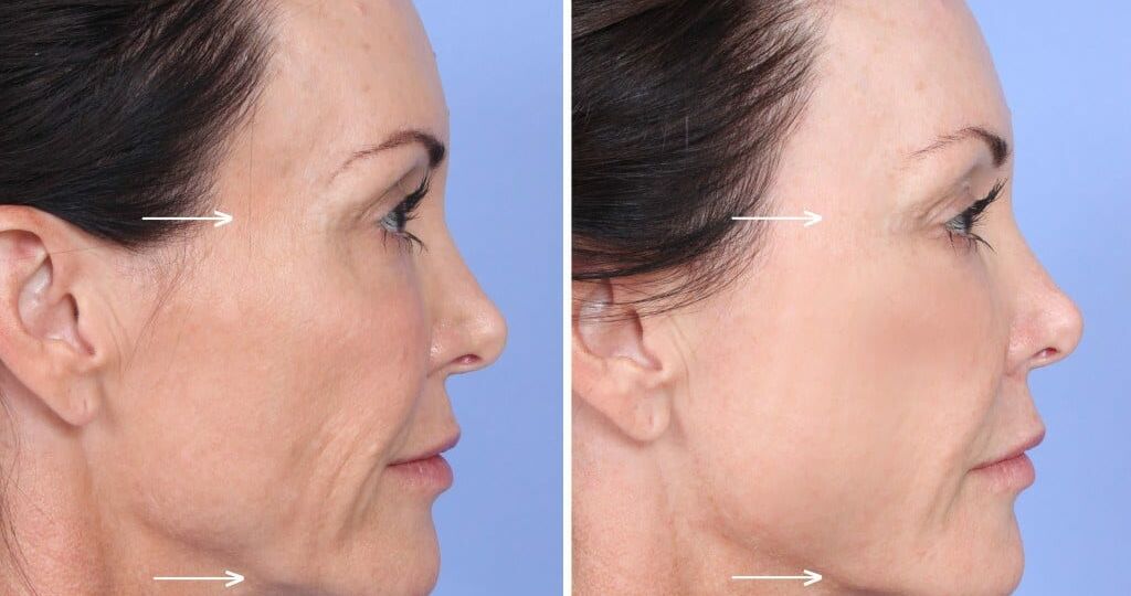 A woman with wrinkles on her face and neck.