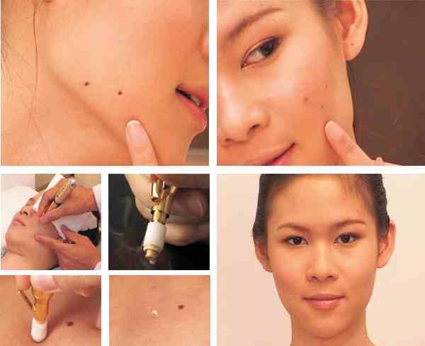 A collage of photos showing how to remove blackheads.