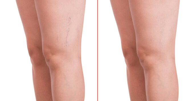 A before and after picture of the legs of two people.