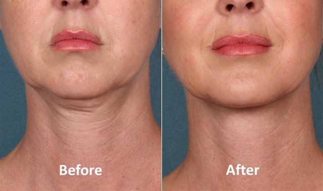 A woman 's face before and after using the neck lift.