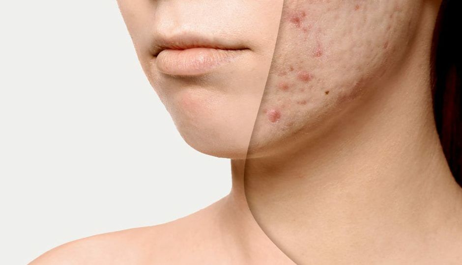 A woman with acne on her face and neck.