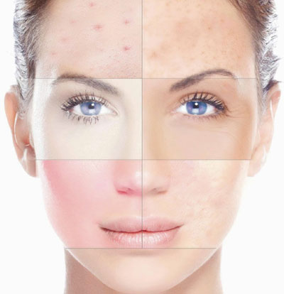 A woman with different types of skin and acne.