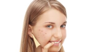 Adult Acne: Popular Questions and Answers