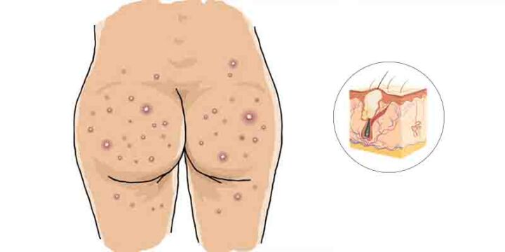 Bum Spots: Why You Get Butt Acne & How To Stop It