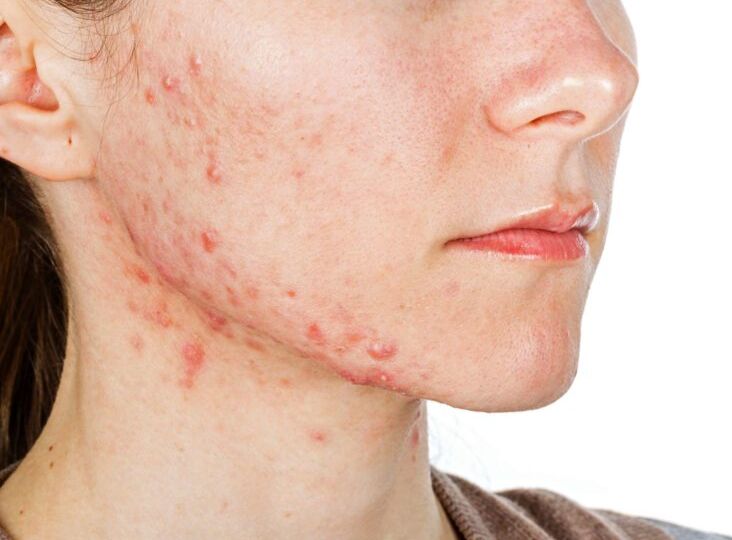 Acne scars: Diagnosis and treatment